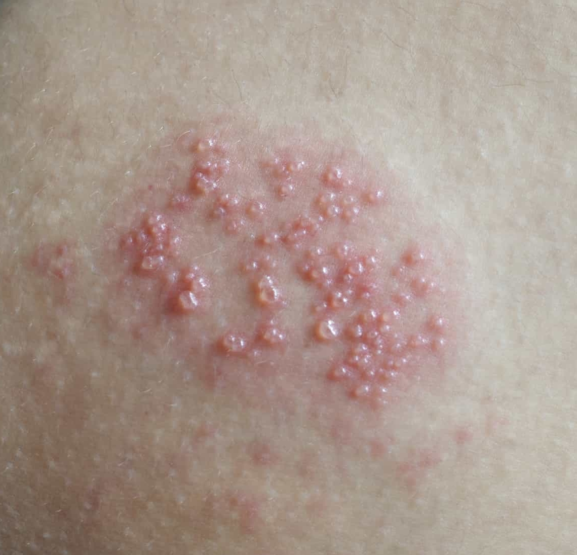 What does a herpes rash look like with pictures 